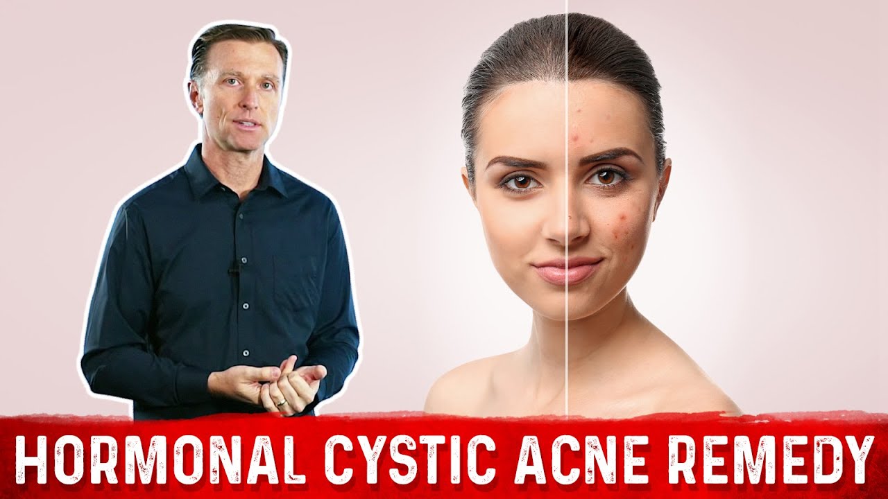 Best Remedy for Hormonal Cystic Acne – Dr.Berg