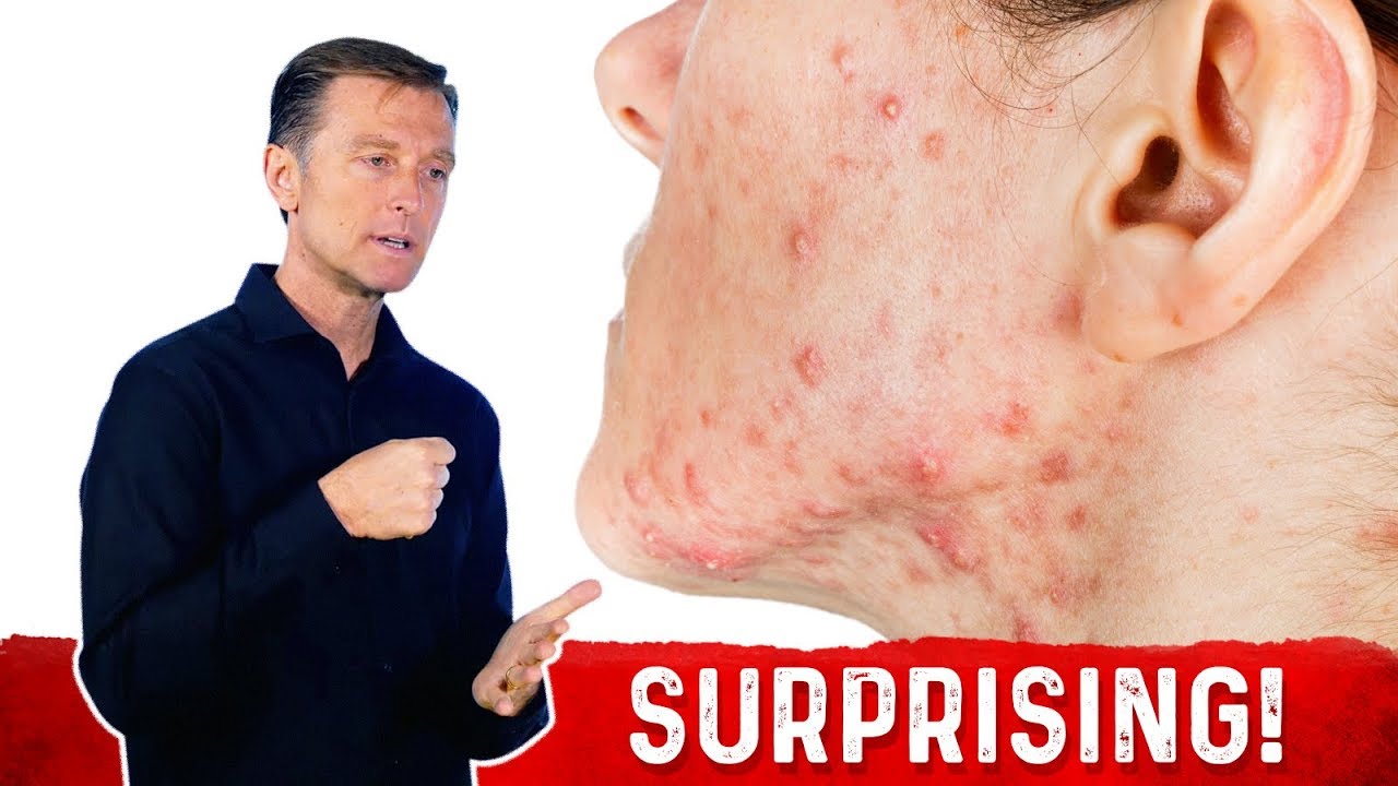 The Hidden Causes of Acne & How to Get Rid of it? – Dr.Berg