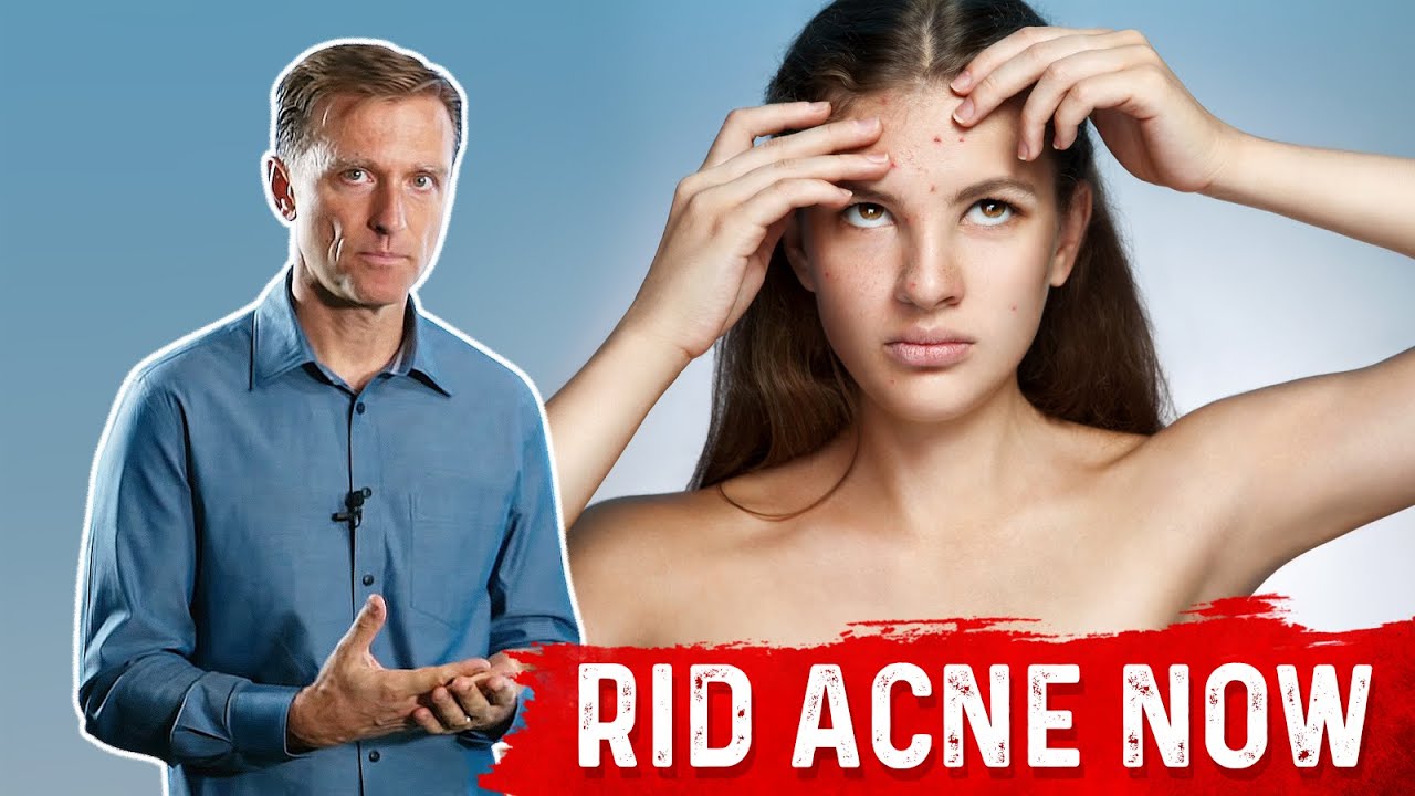 What Causes Acne? – The Surprising Hidden Source of Acne – Dr.Berg