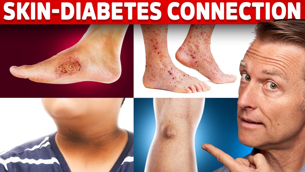 9 Diabetic Skin Problems That Indicate Diabetes