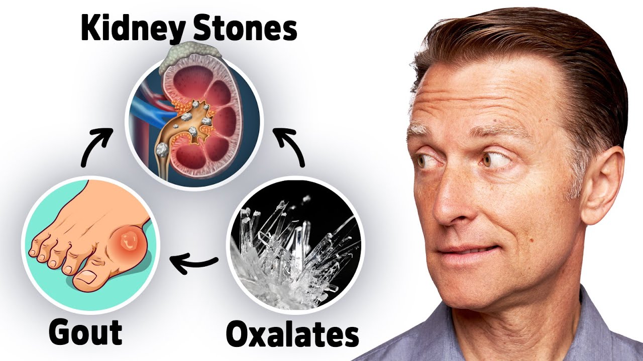 The Connection between Oxalates, Gout, and Kidney Stones