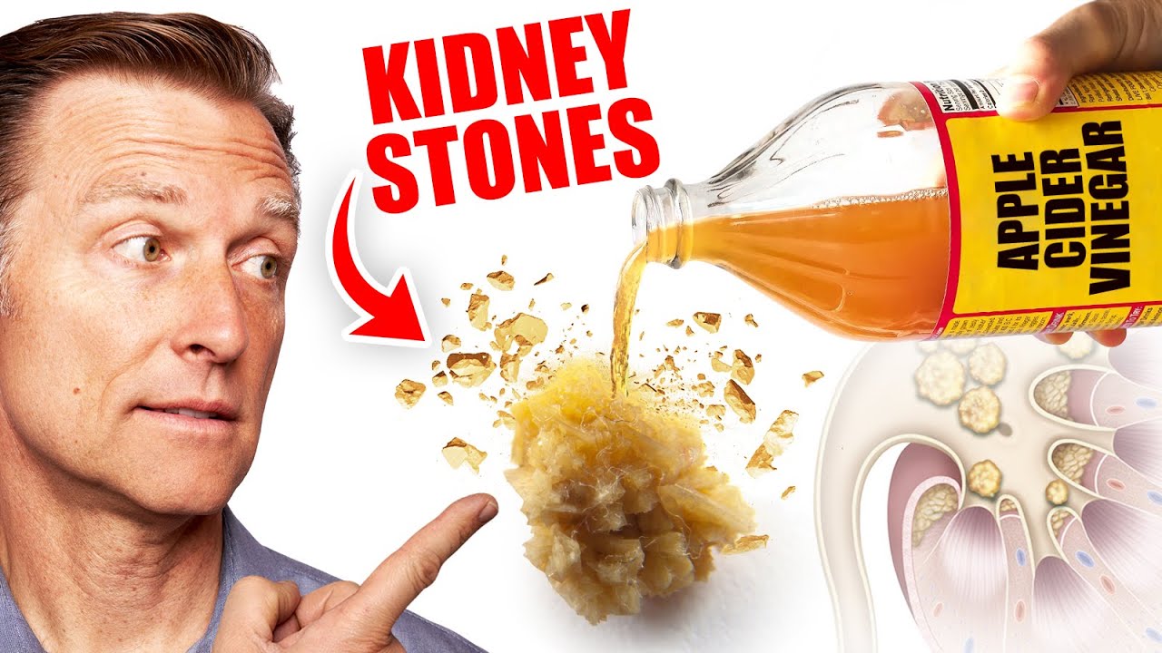 Use Apple Cider Vinegar to Dissolve Kidney Stones