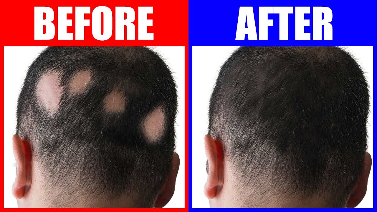 3 Trace Minerals That Can Reverse Alopecia