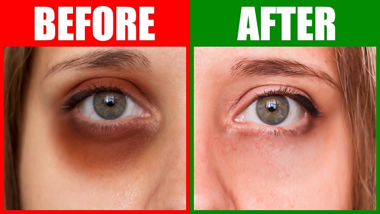 How To Rid Dark Circles Naturally in 24 Hours Gadico Modern